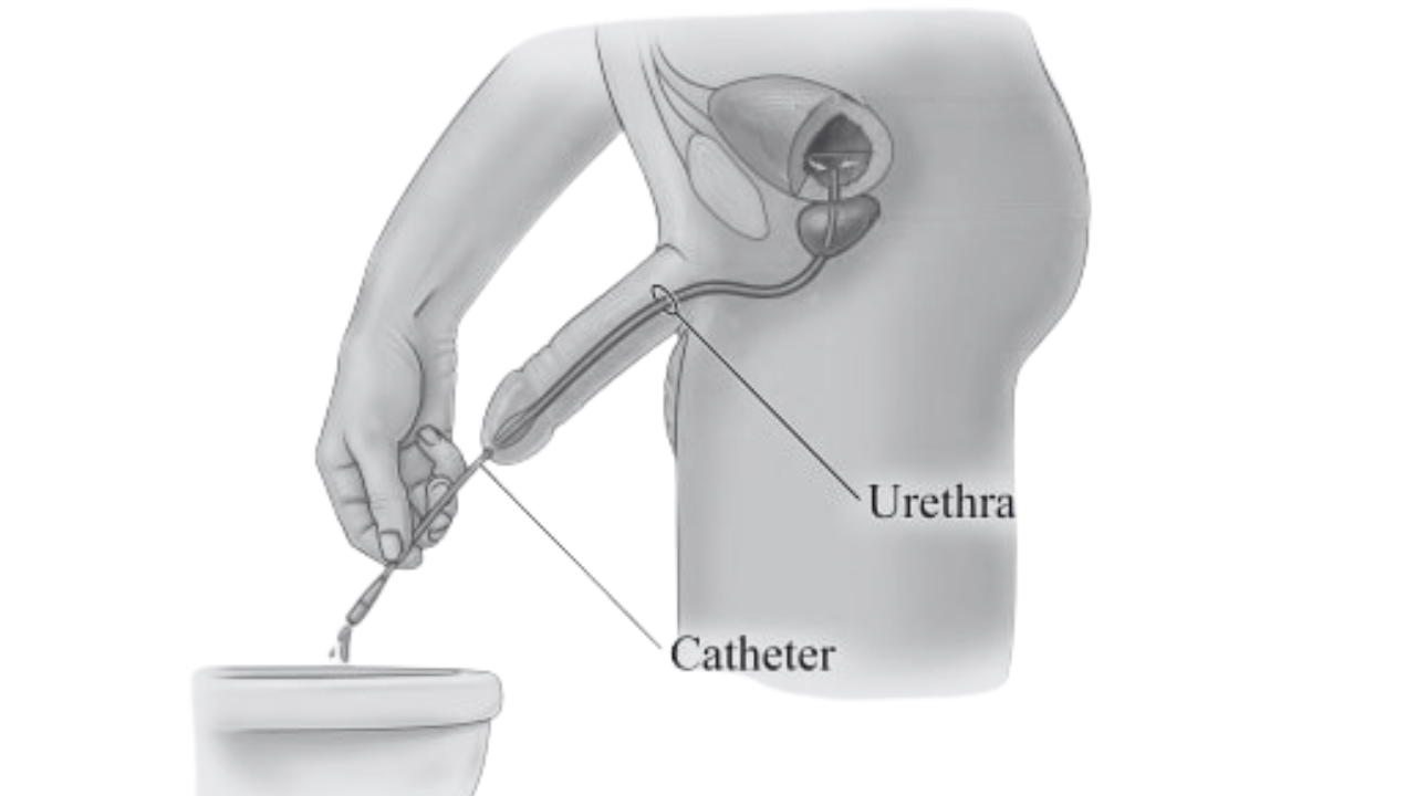 Catheter passed through the urethra for drainage or management